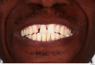 Kato Abimbo teeth 0001.jpg